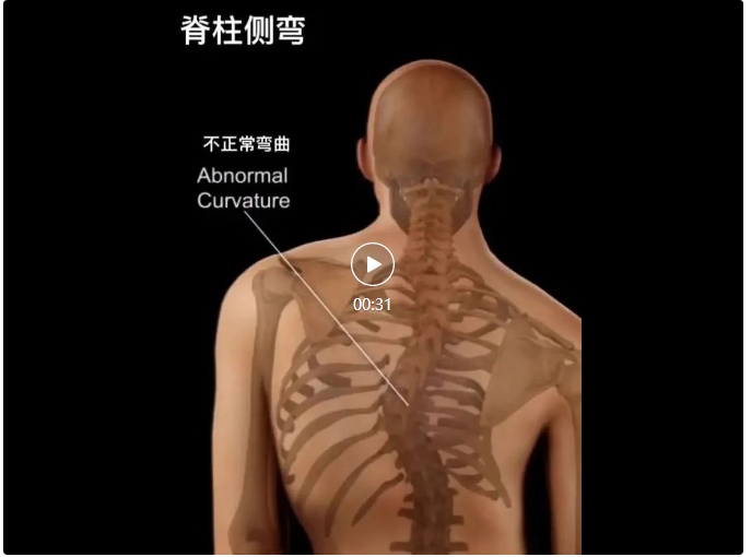 九州行--青少年特發(fā)性脊柱側(cè)凸脊柱融合術(shù)后康復(fù)流程（動圖版）——參考指南，結(jié)合康復(fù)新技術(shù)整理而得